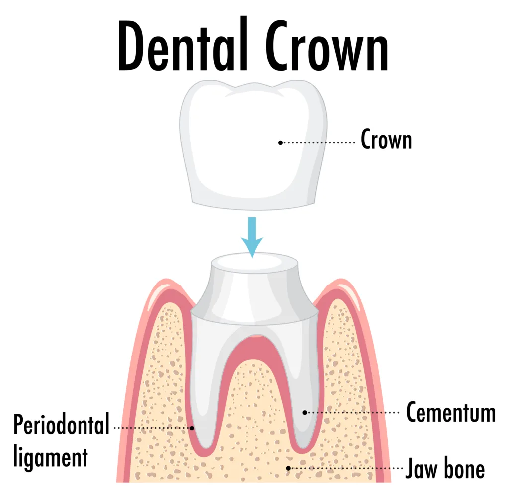 what is a dental crown