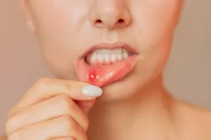 mouth ulcer (canker sore)