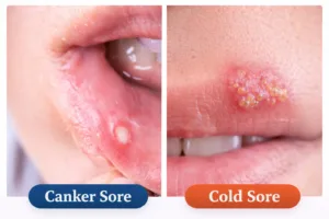canker sore vs cold sore