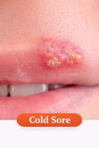 cold sore image