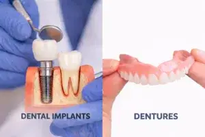 Dental implants vs dentures comparison