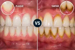 Plaque vs tartar dental comparison
