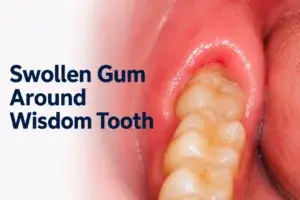 how to treat swollen gums near wisdom tooth