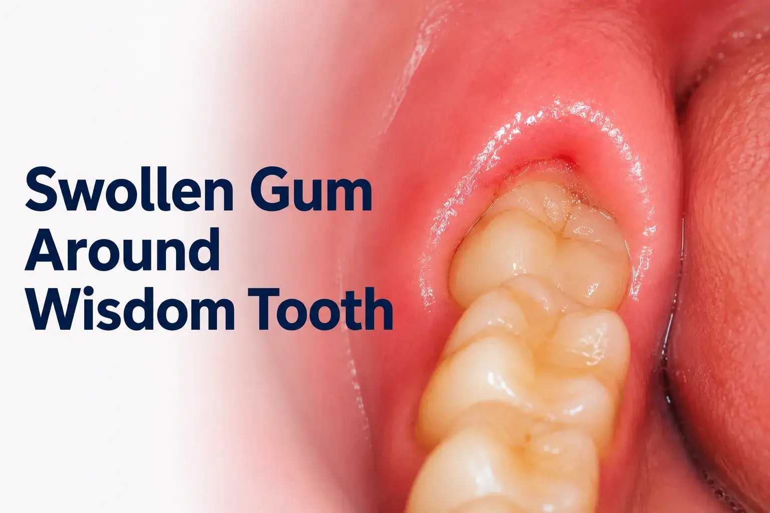 how to treat swollen gums near wisdom tooth